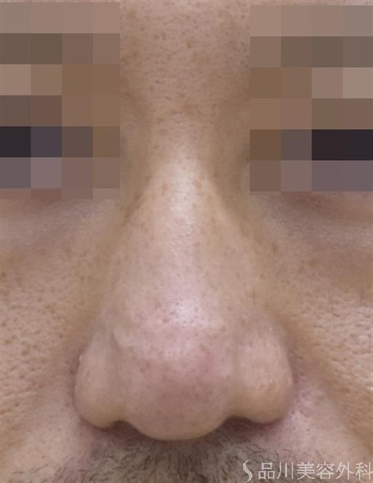 症例NO.48136のAFTER写真