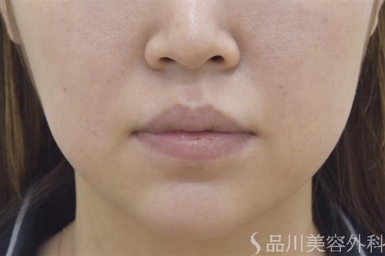 症例NO.47547のBEFORE写真