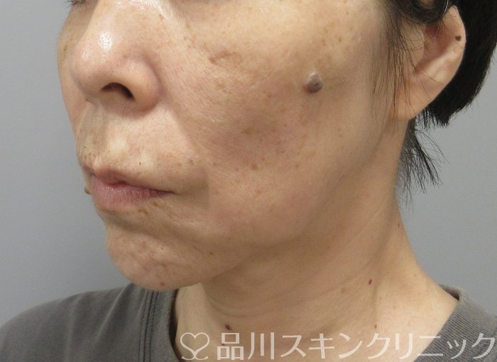 症例NO.73833のAFTER写真