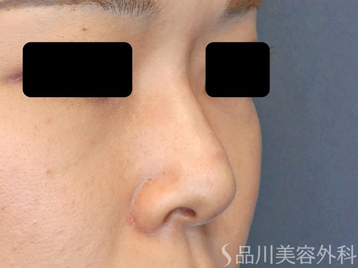 症例NO.70928のAFTER写真