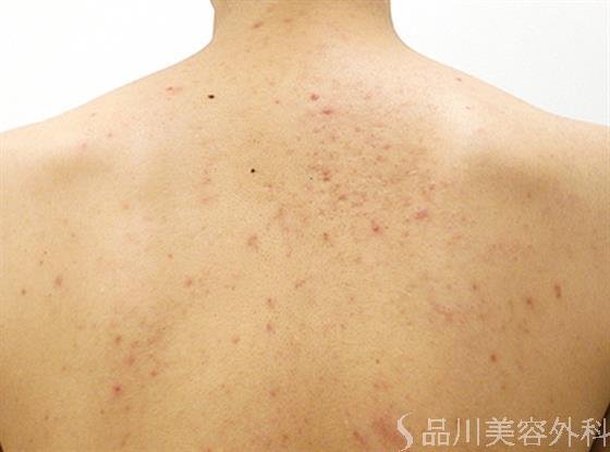 症例NO.23670のAFTER写真