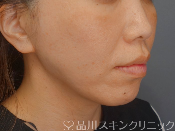 症例NO.74005のAFTER写真