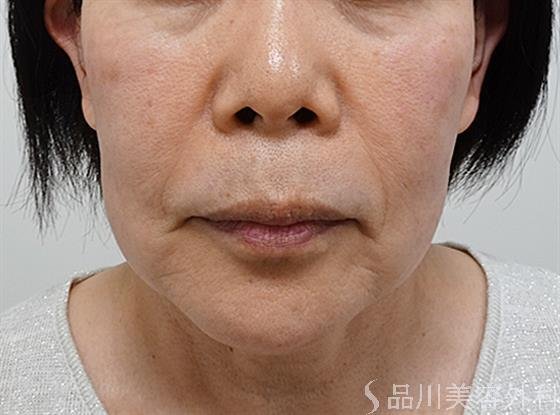 症例NO.55612のBEFORE写真