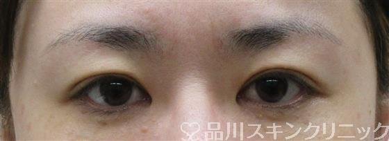 症例NO.61371のBEFORE写真