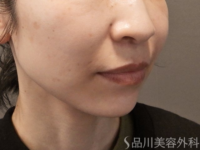 症例NO.74340のBEFORE写真