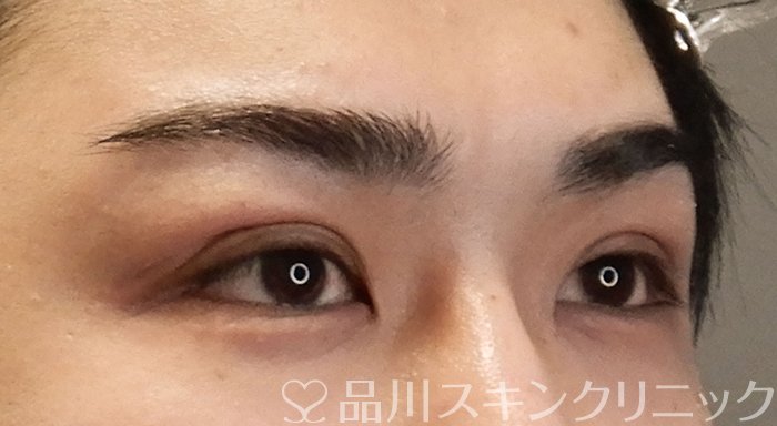 症例NO.70244のAFTER写真
