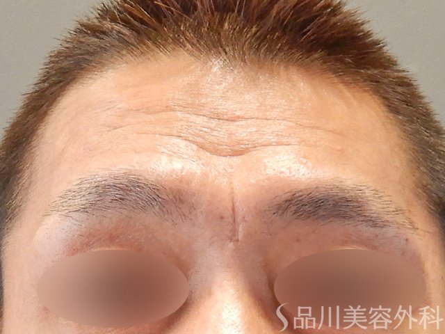症例NO.75248のBEFORE写真