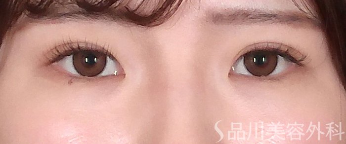 症例NO.70104のAFTER写真