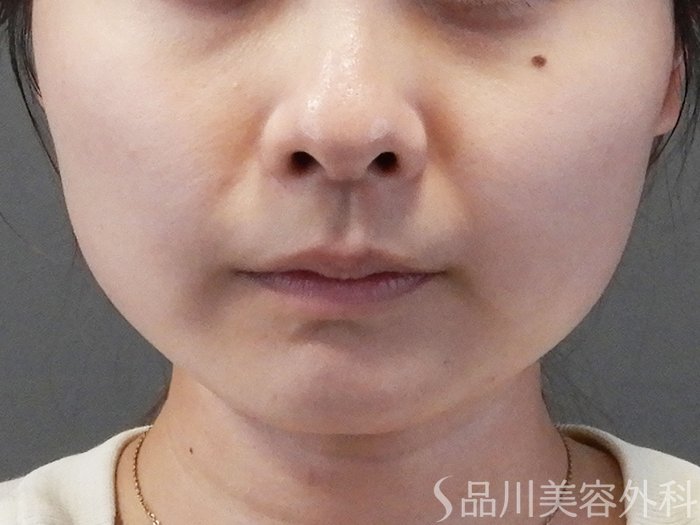 症例NO.70046のBEFORE写真
