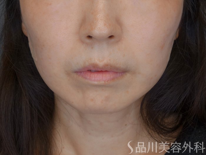 症例NO.71924のAFTER写真