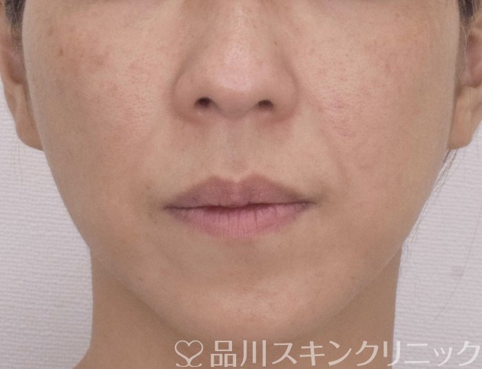 症例NO.72314のBEFORE写真