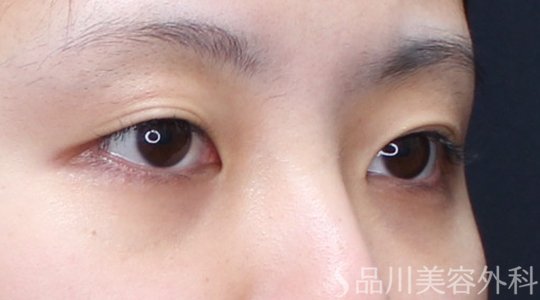症例NO.71720のBEFORE写真