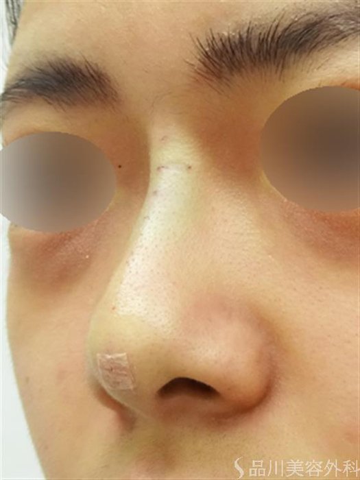 症例NO.42650のAFTER写真