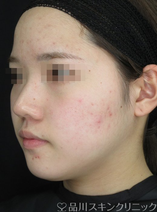 症例NO.72137のBEFORE写真