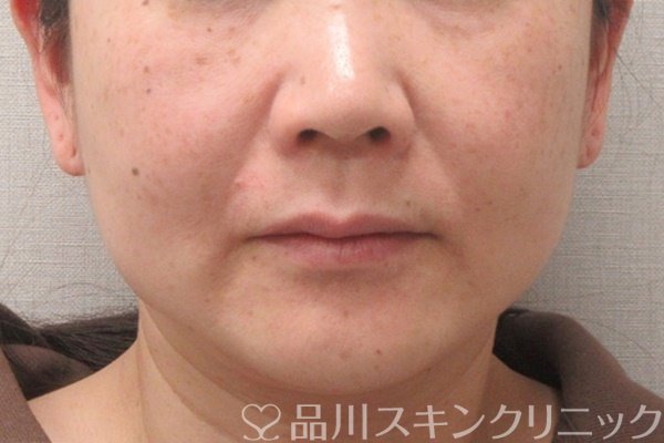 症例NO.74163のBEFORE写真