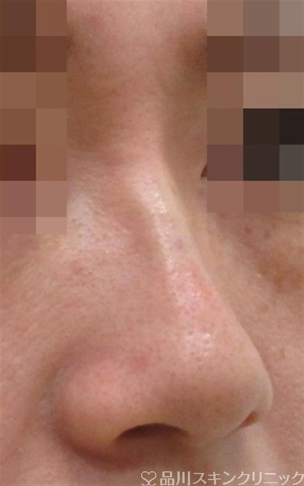 症例NO.42153のAFTER写真