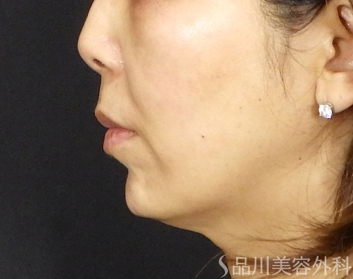 症例NO.71501のAFTER写真