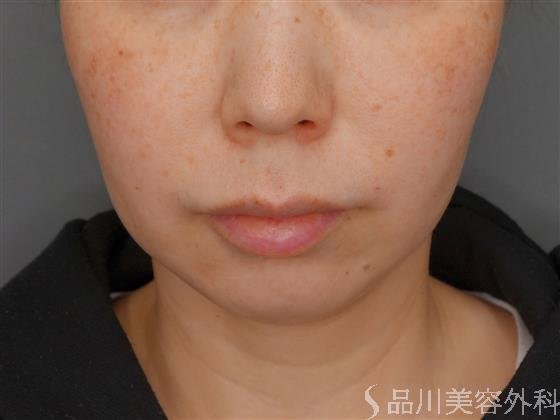 症例NO.59185のBEFORE写真