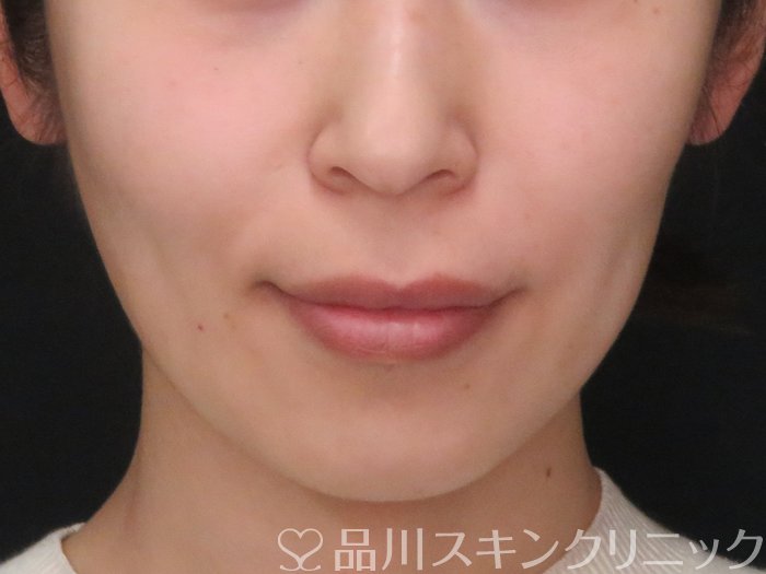 症例NO.69296のBEFORE写真