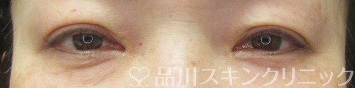 症例NO.70067のAFTER写真