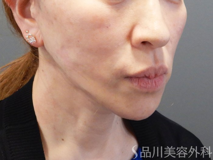 症例NO.74626のAFTER写真