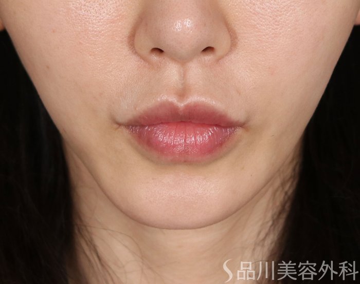 症例NO.73640のAFTER写真