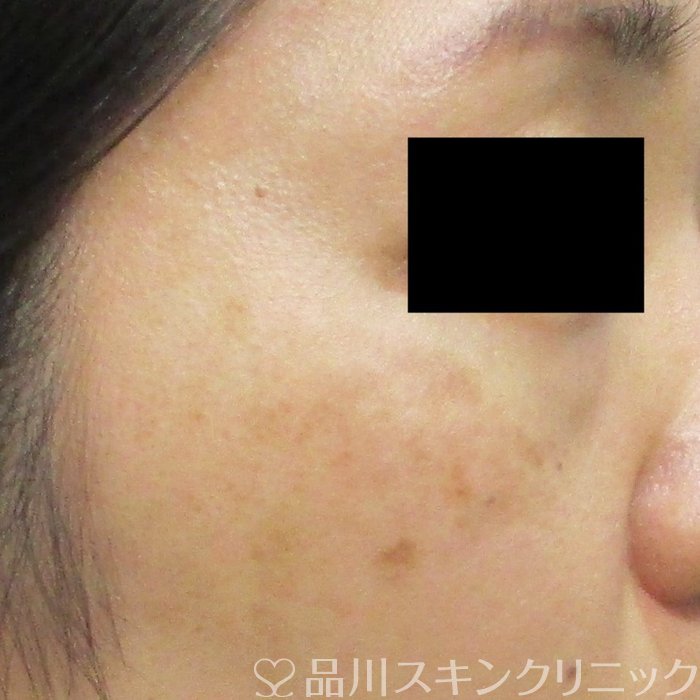 症例NO.68148のAFTER写真