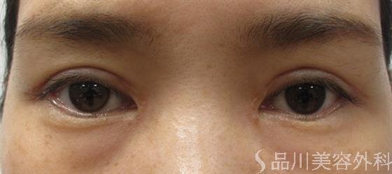 症例NO.43927のAFTER写真
