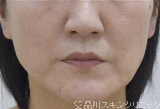 症例NO.53432のBEFORE写真