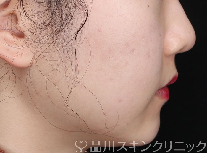 症例NO.71067のAFTER写真