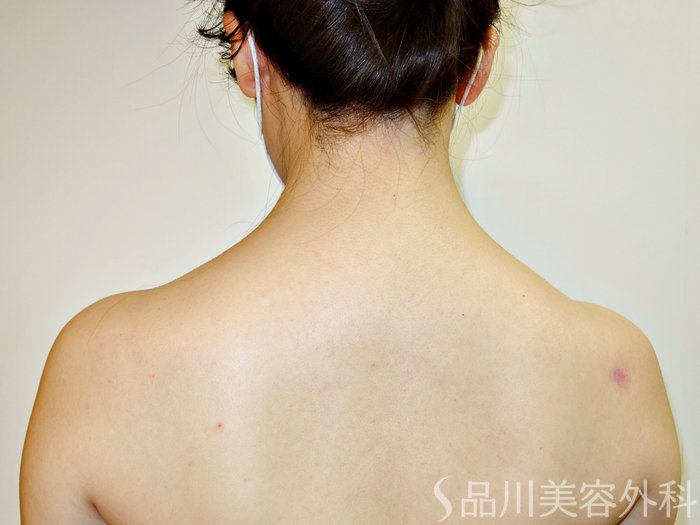 症例NO.73204のBEFORE写真