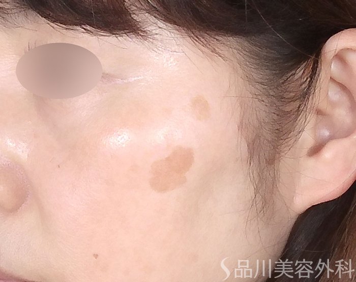 症例NO.70720のBEFORE写真