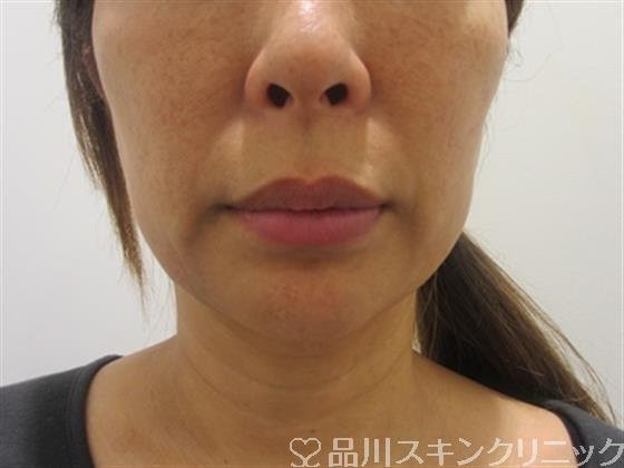 症例NO.37773のBEFORE写真