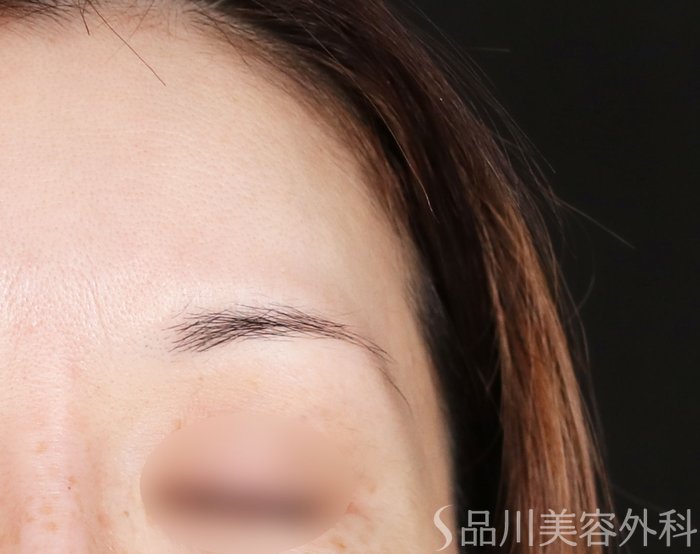 症例NO.72586のBEFORE写真