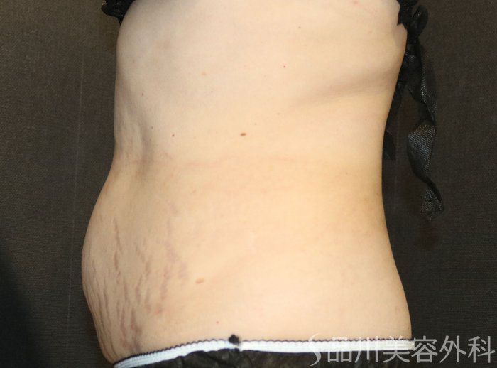 症例NO.72258のBEFORE写真