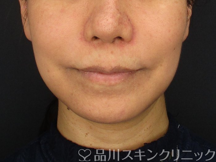 症例NO.69861のAFTER写真