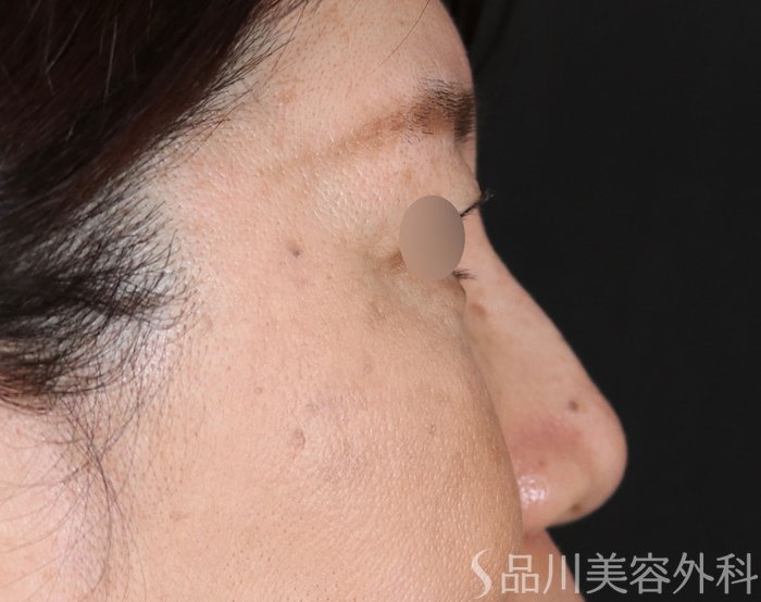 症例NO.71073のBEFORE写真