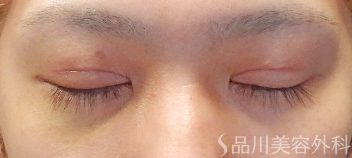 症例NO.68281のAFTER写真