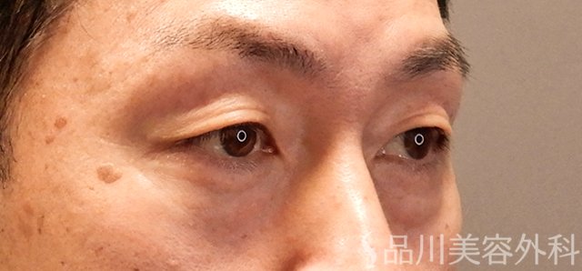 症例NO.70550のBEFORE写真