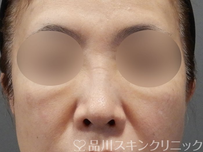 症例NO.75044のBEFORE写真