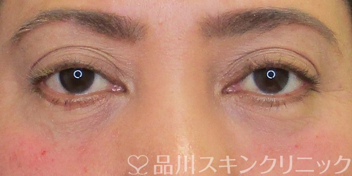 症例NO.69014のAFTER写真