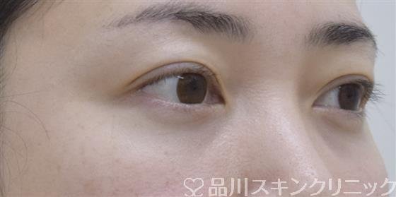 症例NO.52948のAFTER写真