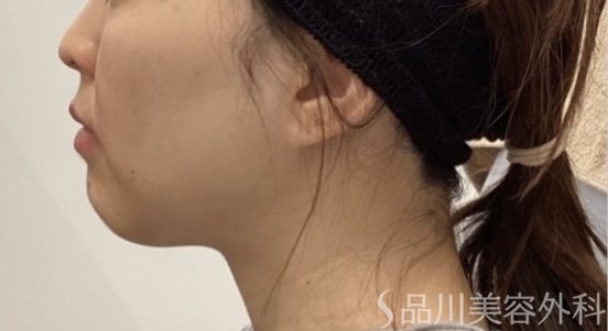 症例NO.75168のBEFORE写真