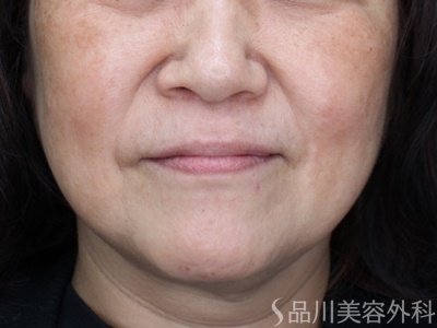 症例NO.72392のBEFORE写真