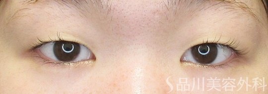 症例NO.69867のBEFORE写真