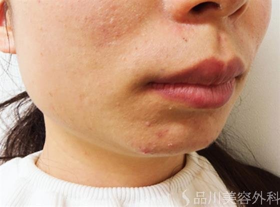 症例NO.33010のBEFORE写真
