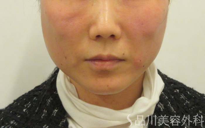 症例NO.73546のAFTER写真