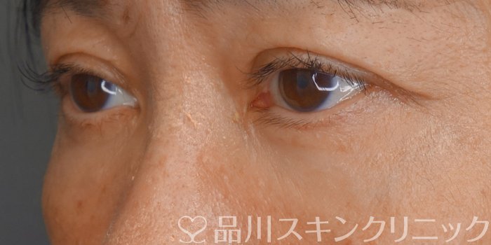 症例NO.71475のAFTER写真
