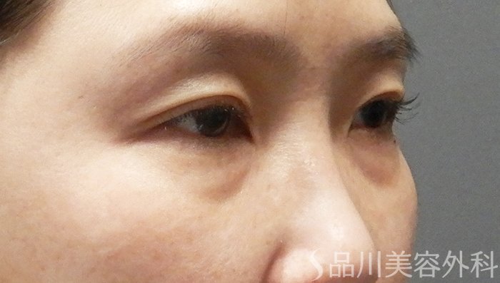 症例NO.65368のBEFORE写真