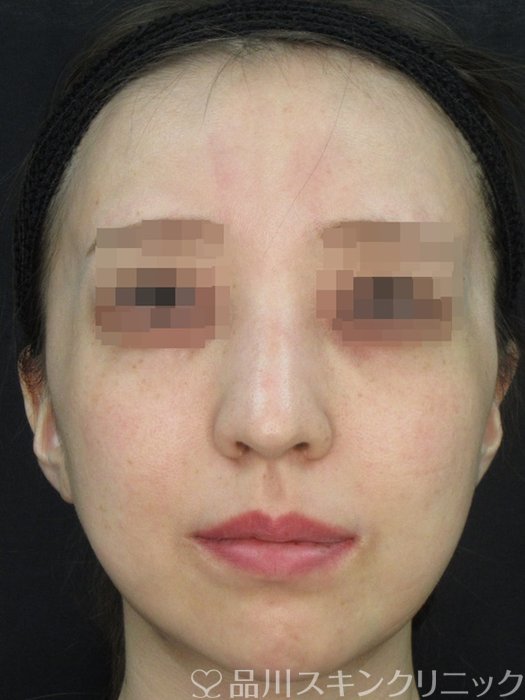 症例NO.72463のAFTER写真